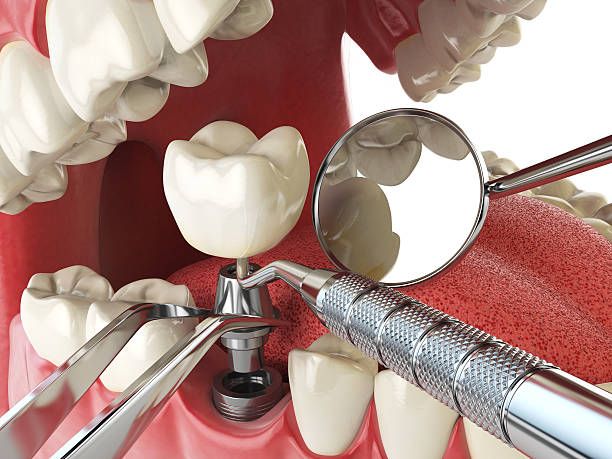 Best Emergency Dental Care for Broken or Chipped Teeth in Fort Valley, GA